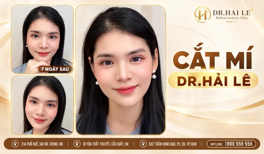Hình ảnh khách hàng sau cắt mí 7 ngày tại Dr. Hải Lê qua các góc chụp gương mặt.