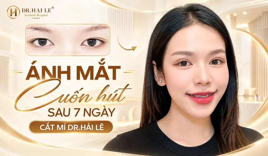 Gương mặt khách hàng sau cắt mí 7 ngày, kèm ảnh đối chiếu tình trạng đôi mắt ban đầu.