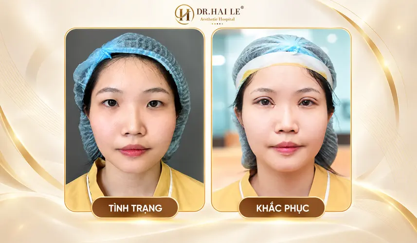 Hình ảnh chính diện của khách hàng trước và sau cắt mí, đối chiếu nếp mí hai bên.
