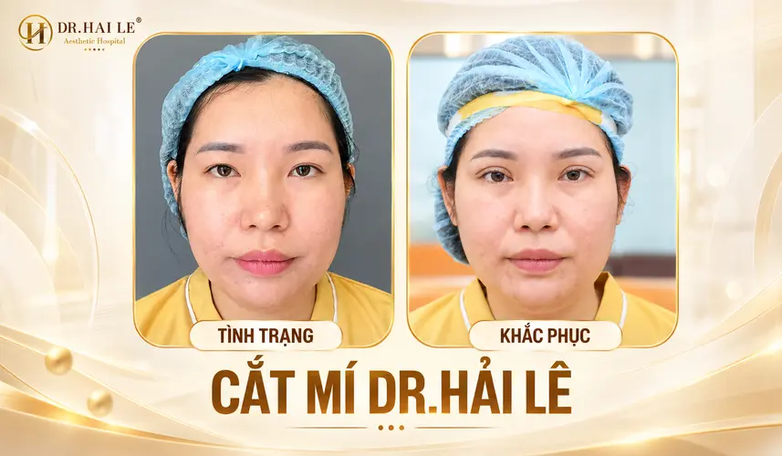 Hình ảnh tình trạng đôi mắt ban đầu và thay đổi sau cắt mí của khách hàng tại Dr. Hải Lê.
