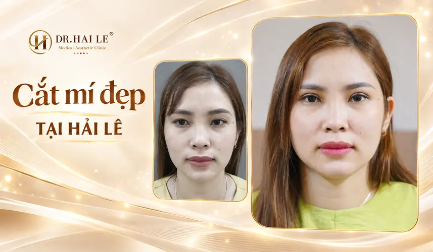 Đôi mắt có nếp mí rõ, hài hòa với gương mặt khách hàng sau cắt mí tại Dr. Hải Lê.