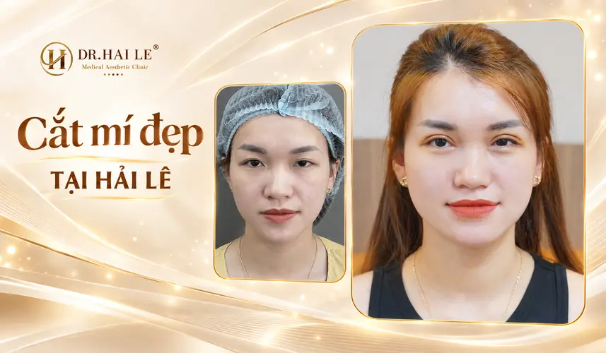 Nếp mí cong nhẹ, đôi mắt trông tươi tắn sau cắt mí tại Dr. Hải Lê.