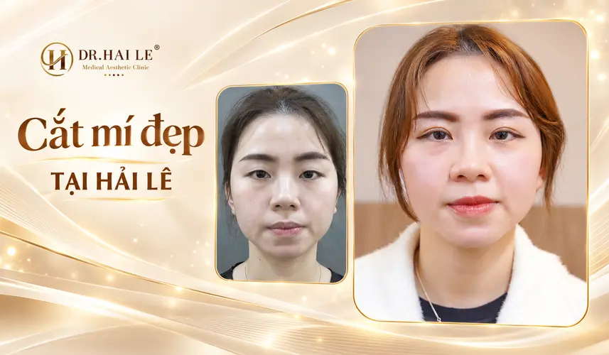 Đôi mắt với đường mí mềm mại, hài hòa cùng nụ cười sau cắt mí tại Dr. Hải Lê.