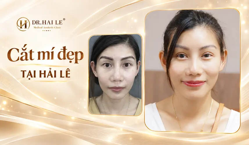 Nếp mí rõ nét giúp đôi mắt thêm nổi bật trên gương mặt sau cắt mí tại Dr. Hải Lê.