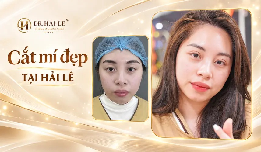 Đôi mắt có nếp mí thanh mảnh, tạo nét dịu dàng cho gương mặt sau cắt mí tại Dr. Hải Lê.