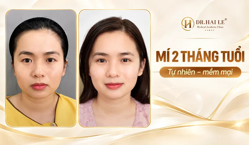 So sánh đôi mắt của khách hàng trước cắt mí và sau 2 tháng tại Dr. Hải Lê.