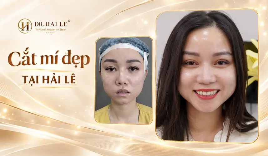 Hình ảnh chính diện đôi mắt với nếp mí rõ và đường cong nhẹ sau cắt mí tại Dr. Hải Lê.