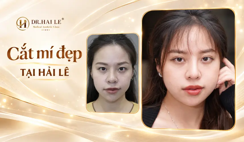 Đôi mắt tươi tắn, hài hòa với gương mặt khi cười sau cắt mí tại Dr. Hải Lê.