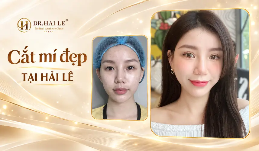 Nếp mí mềm mại làm nổi bật ánh nhìn của khách hàng sau cắt mí tại Dr. Hải Lê.