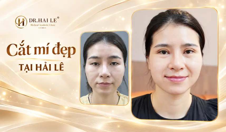 Đôi mắt có nếp mí rõ, ánh nhìn cuốn hút sau cắt mí tại Dr. Hải Lê.