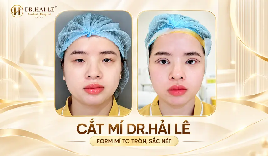 Cắt da thừa mí mắt trên: Những thông tin cần biết? 5 Hình ảnh đôi mắt trước và sau cắt mí tại Dr. Hải Lê, thể hiện sự thay đổi của nếp mí.