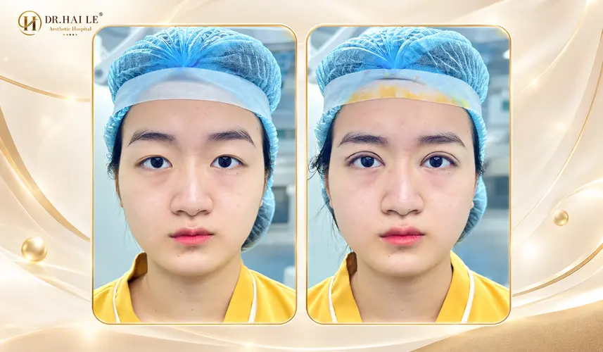 So sánh nếp mí của khách hàng trước và sau thực hiện cắt mí qua góc chụp chính diện.