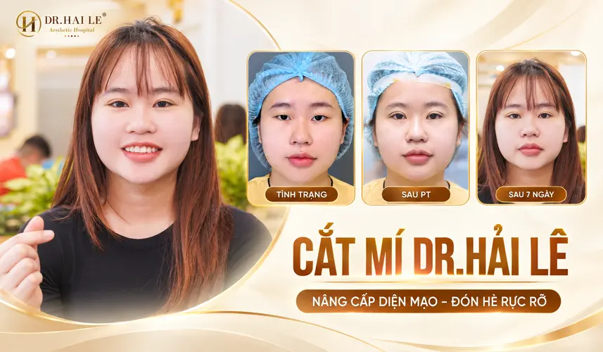 Quá trình thay đổi đôi mắt của khách hàng trước cắt mí, ngay sau phẫu thuật và sau 7 ngày.