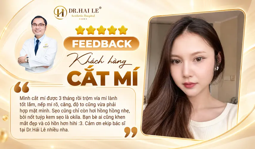 Hình ảnh và chia sẻ của khách hàng về nếp mí, quá trình hồi phục sau cắt mí 3 tháng.