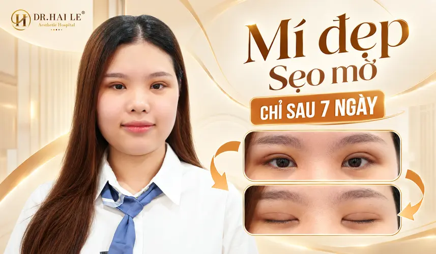 Cận cảnh nếp mí khi mở mắt và đường sẹo khi nhắm mắt của khách hàng sau cắt mí 7 ngày.
