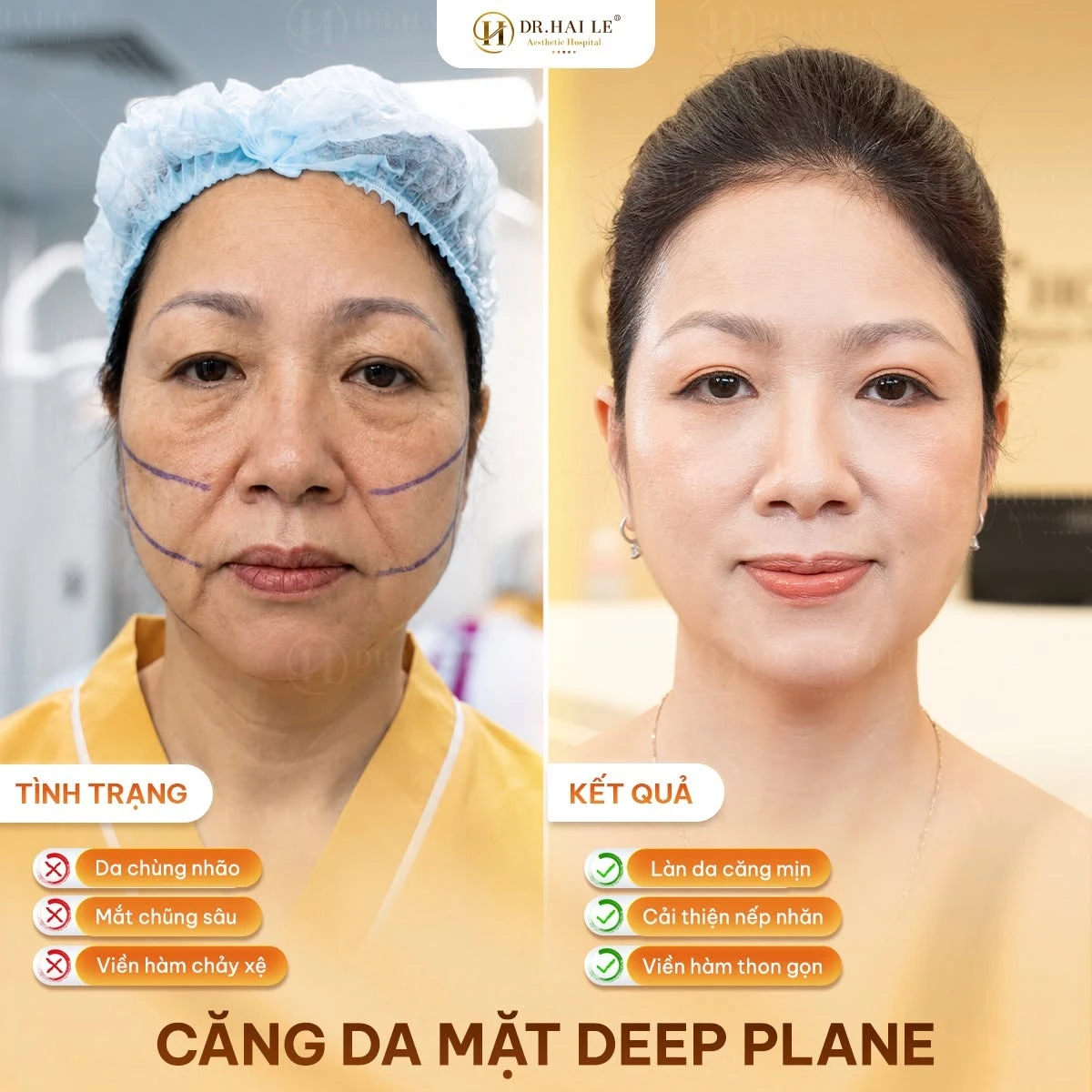Căng da mặt tại Bệnh viện Thẩm mỹ Dr Hải Lê – Hệ sinh thái căng da trẻ hoá 5 cang da mat tai benh vien tham my dr hai le he sinh thai cang da tre hoa 002